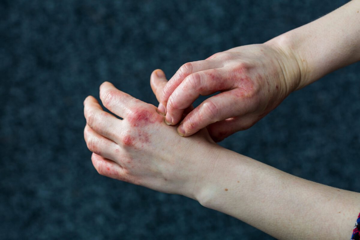 濕疹在身體上的位置反映不同的皮膚病狀況
