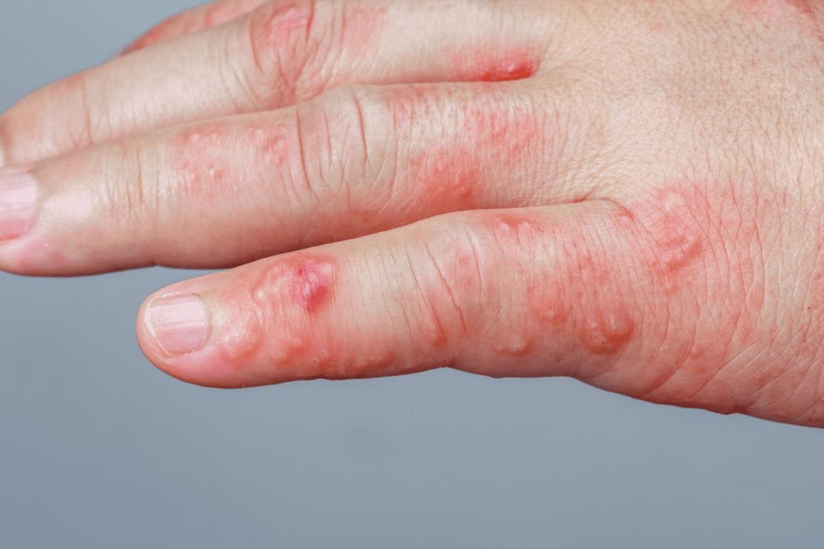 生蛇症狀可表現為皮膚紅斑、乾燥、發癢、皮屑和皮膚粗糙-1200x800.png