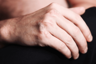 銀屑病 (牛皮癬) 是一種常見的皮膚疾病
