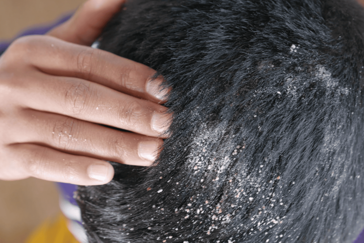 銀屑病-牛皮癬-會導致皮膚表面出現變厚脫屑的斑塊-1200x801.png