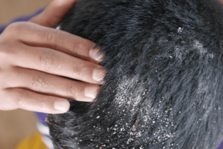 銀屑病 (牛皮癬) 會導致皮膚表面出現變厚脫屑的斑塊